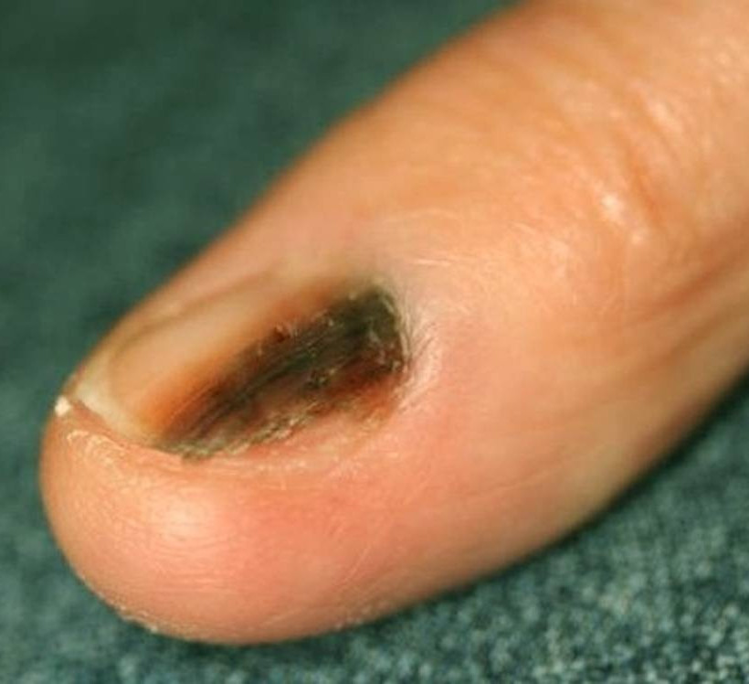 Προσοχή: Τι πρέπει να κάνετε αν δείτε αυτές τις γραμμές στα νύχια σας!