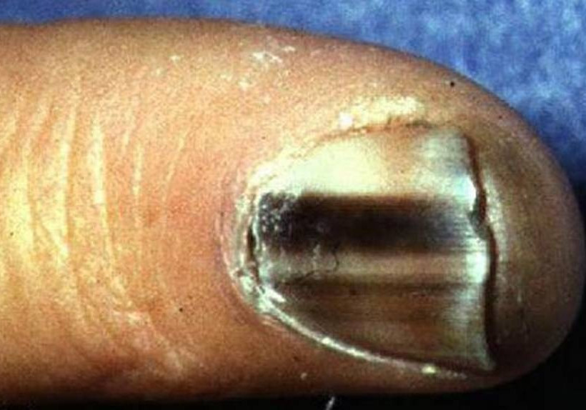 Προσοχή: Τι πρέπει να κάνετε αν δείτε αυτές τις γραμμές στα νύχια σας!