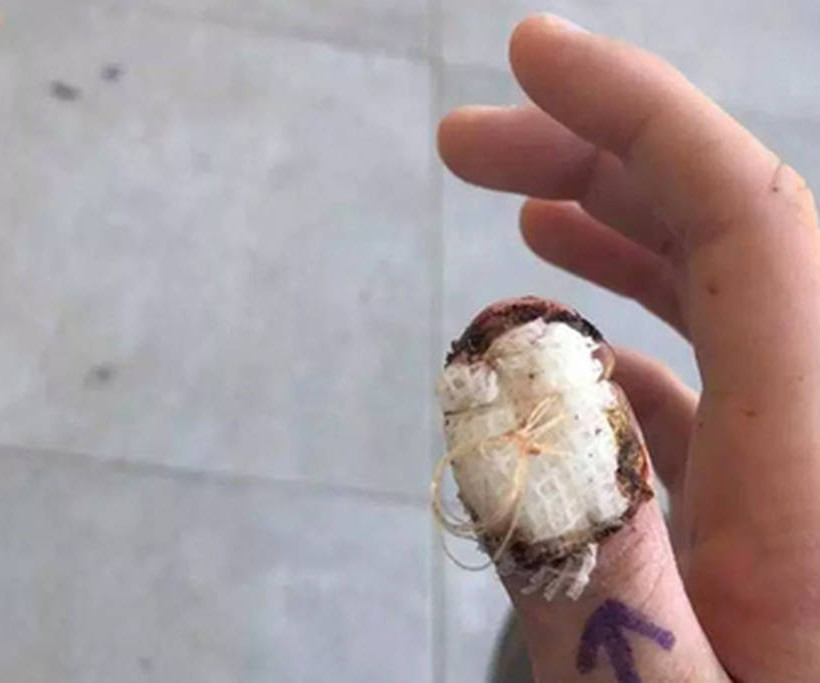 Εικόνες ΣΟΚ: Έτρωγε τα νύχια της και προκάλεσε τον εφιάλτη της! Αναγκάστηκαν να την ακρωτηριάσουν