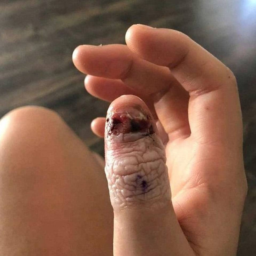 Εικόνες ΣΟΚ: Έτρωγε τα νύχια της και προκάλεσε τον εφιάλτη της! Αναγκάστηκαν να την ακρωτηριάσουν