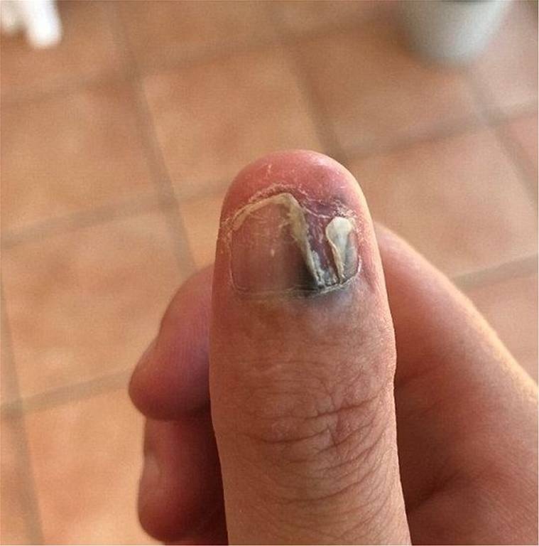 Εικόνες ΣΟΚ: Έτρωγε τα νύχια της και προκάλεσε τον εφιάλτη της! Αναγκάστηκαν να την ακρωτηριάσουν