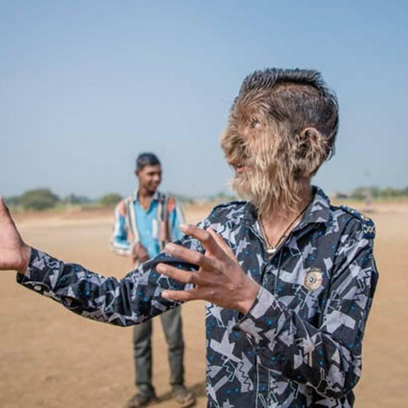 Το παιδί-λυκάνθρωπος