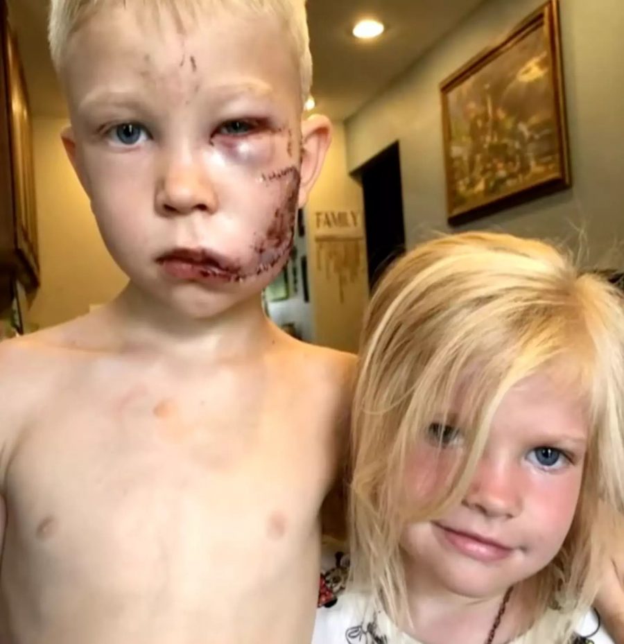 The boy needed 90 stitches (YouTube/WPLG Local 10)