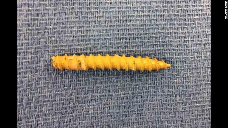 180125171456 04 screw skull accident exlarge 169