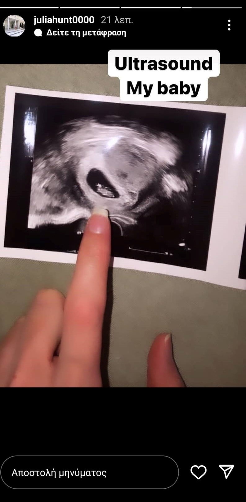 τζουλια αλεξανδράτου υπερηχος