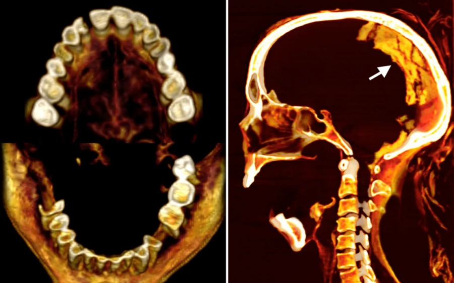 screaming-mummy-ct-brain.jpg