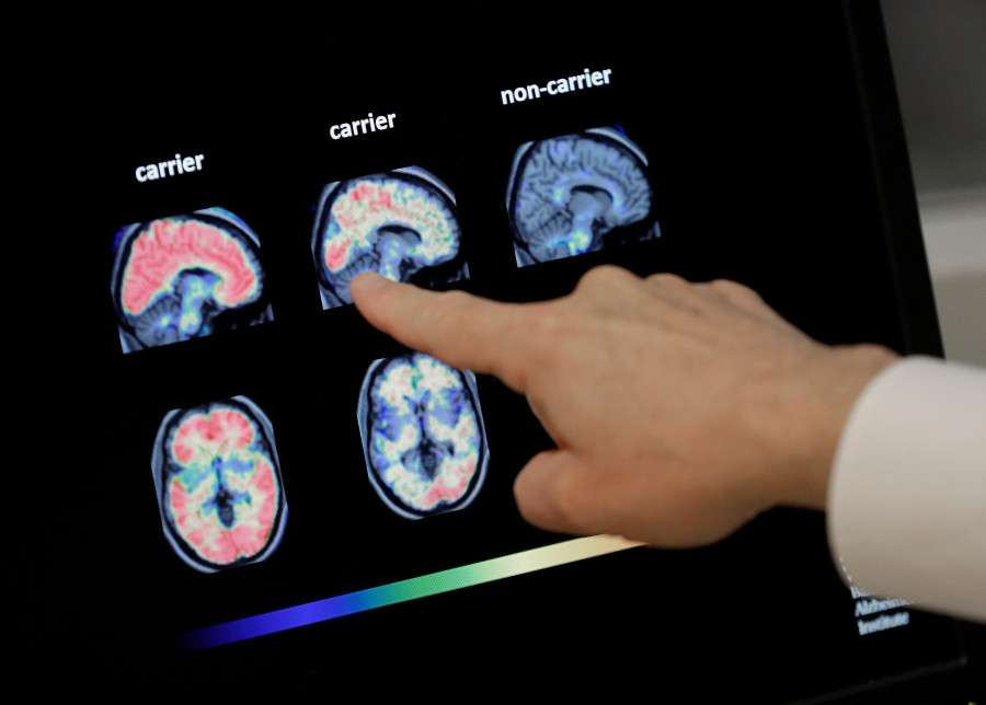 Dementia Risk