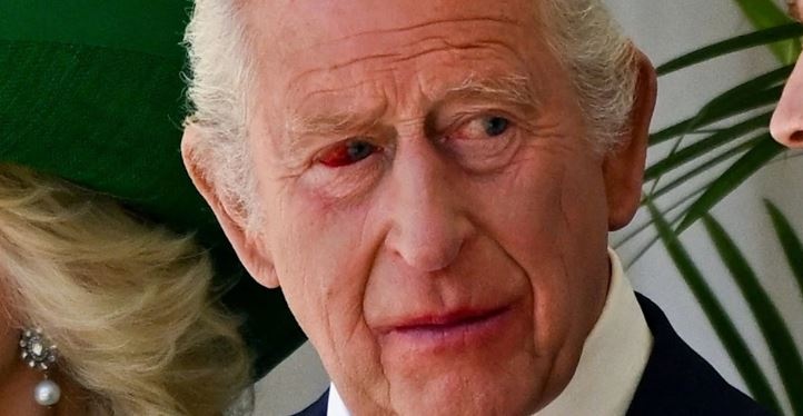 charles-eye.jpg