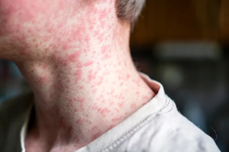 measles-rash.jpg