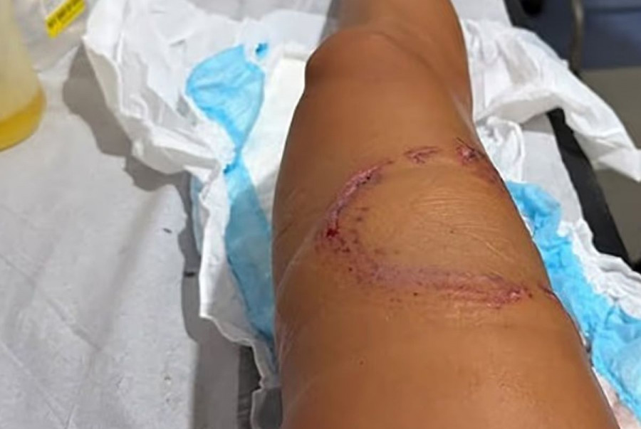 Ο καρχαρίας την δάγκωσε στο πόδι