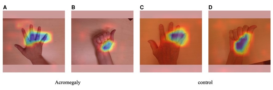 ερευνα ΑΙ ακρομεγαλια