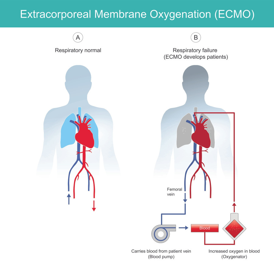 Extracorporeal Membrane Oxygenation