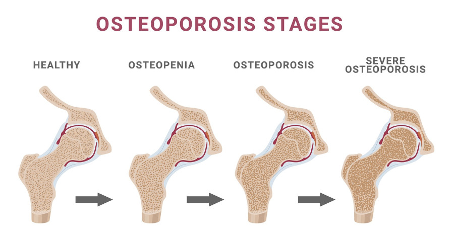 οστα οστεοπορωση