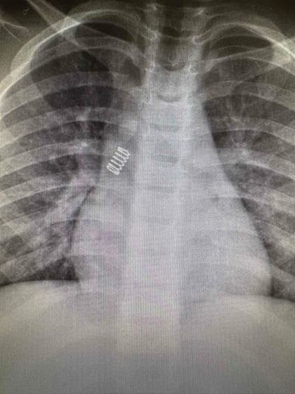 Ακτινογραφία - Ελατήριο 