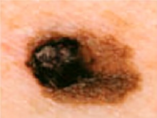 melanoma-asymmetry.jpg