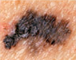 melanoma-border.jpg