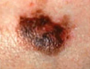 melanoma-color.jpg