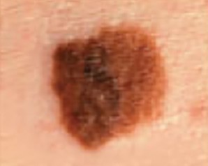 melanoma-diameter-or-dark.jpg