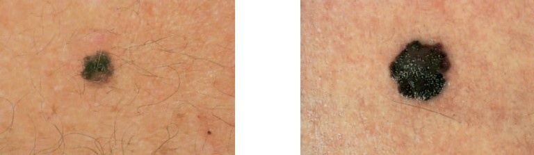 melanoma-evolving-before-after.jpg