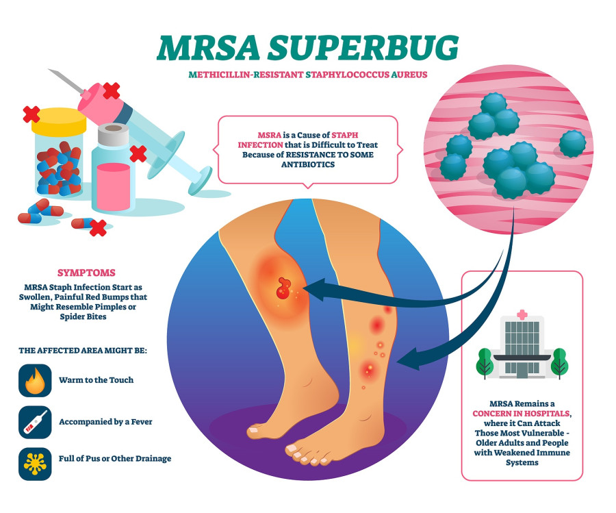 Mrsa σταφυλοκοκκος