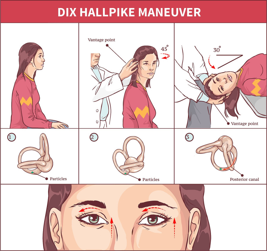 τεχνικη Dix Hallpike για τον ιλιγγο
