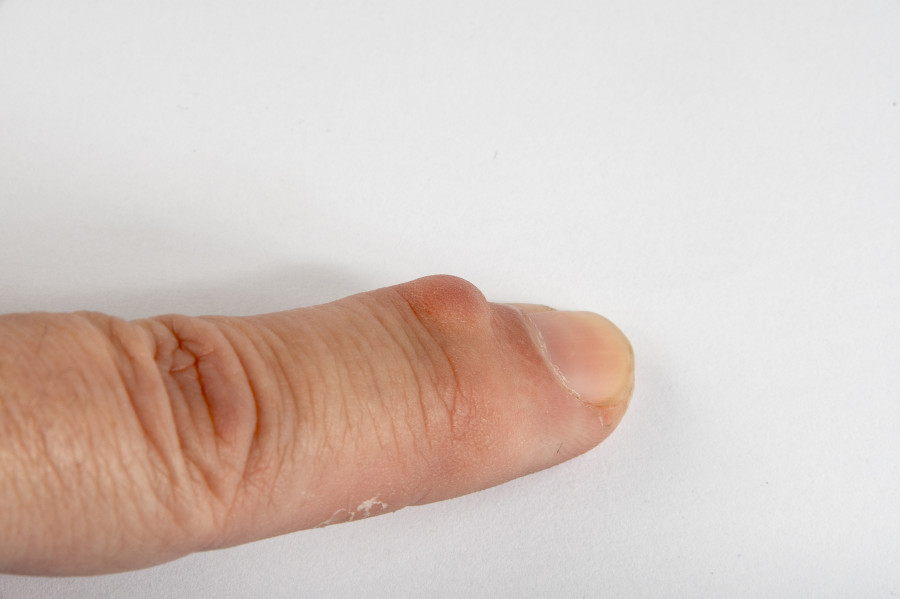 Ganglion Cysts