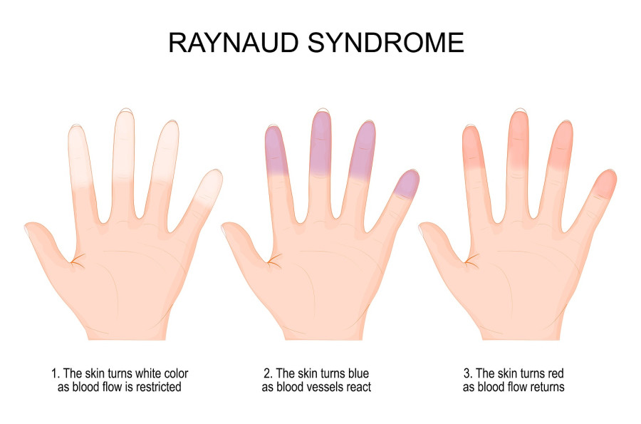 συνδρομο Raynaud