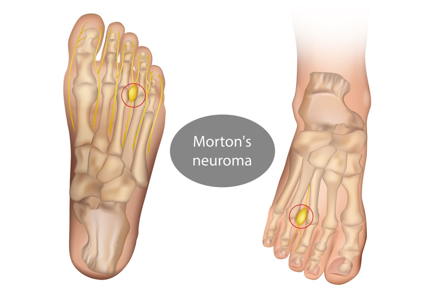 Νεύρωμα Morton