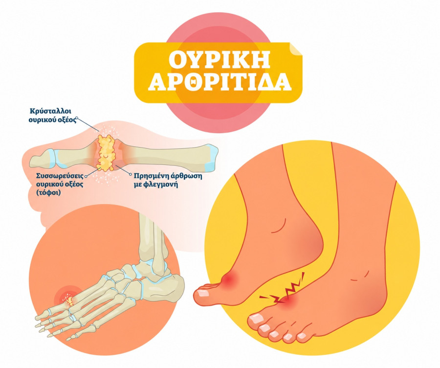gout-illustration-greek.jpg