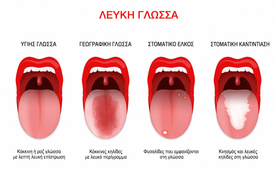 λευκη γλωσσα