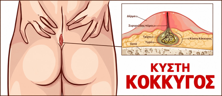κυστη κοκκυγος