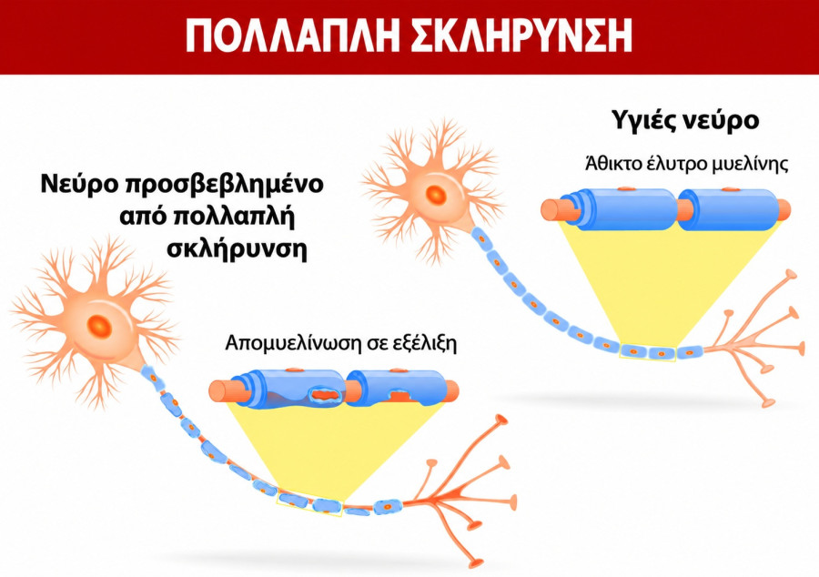 πολλαπλη σκληρυνση