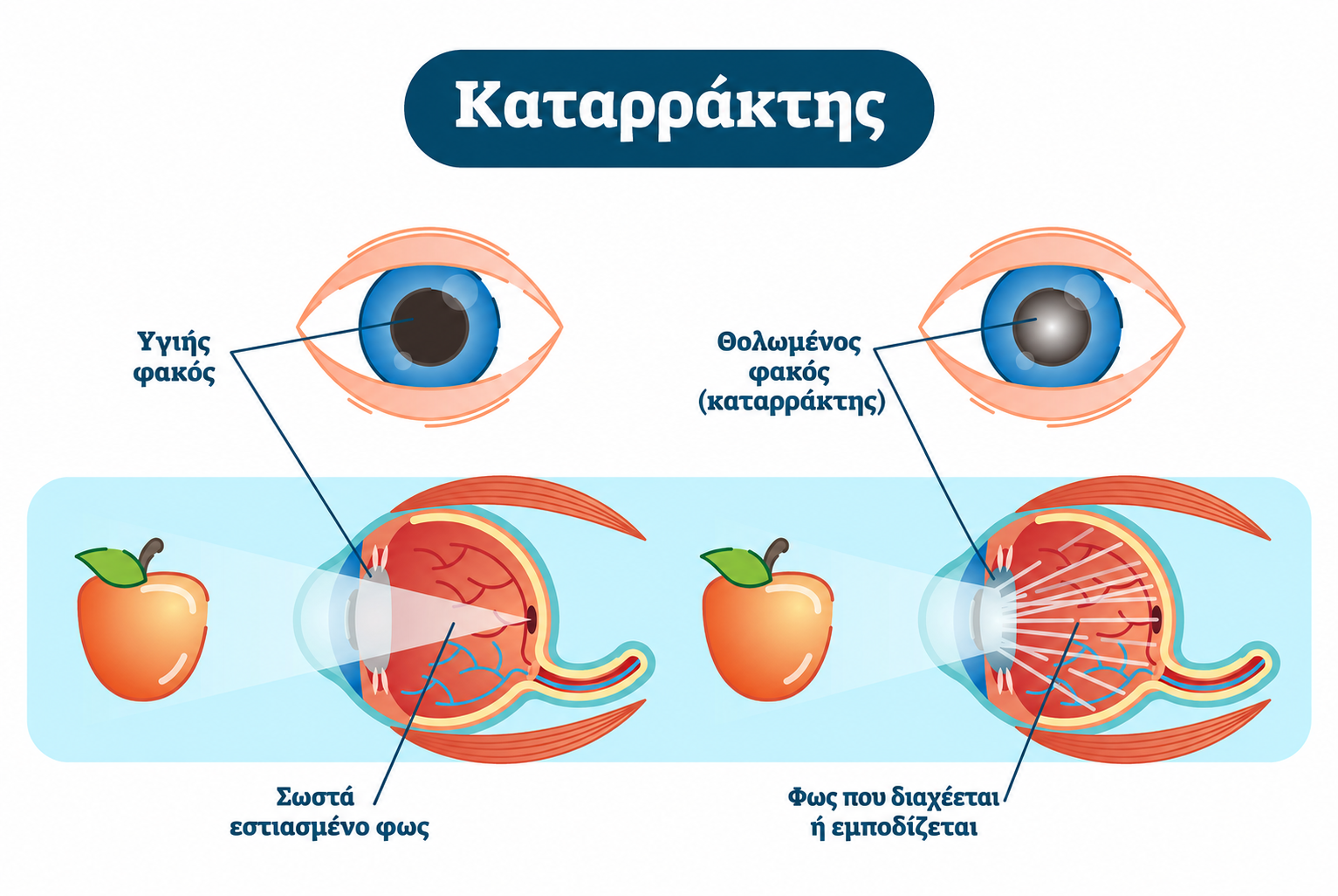 καταρρακτης