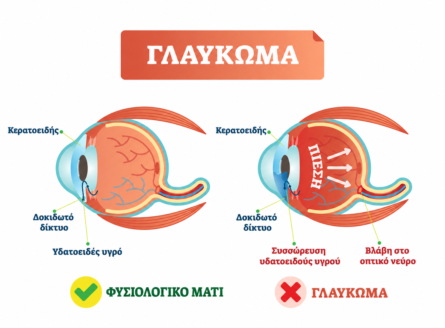 γλαυκωμα