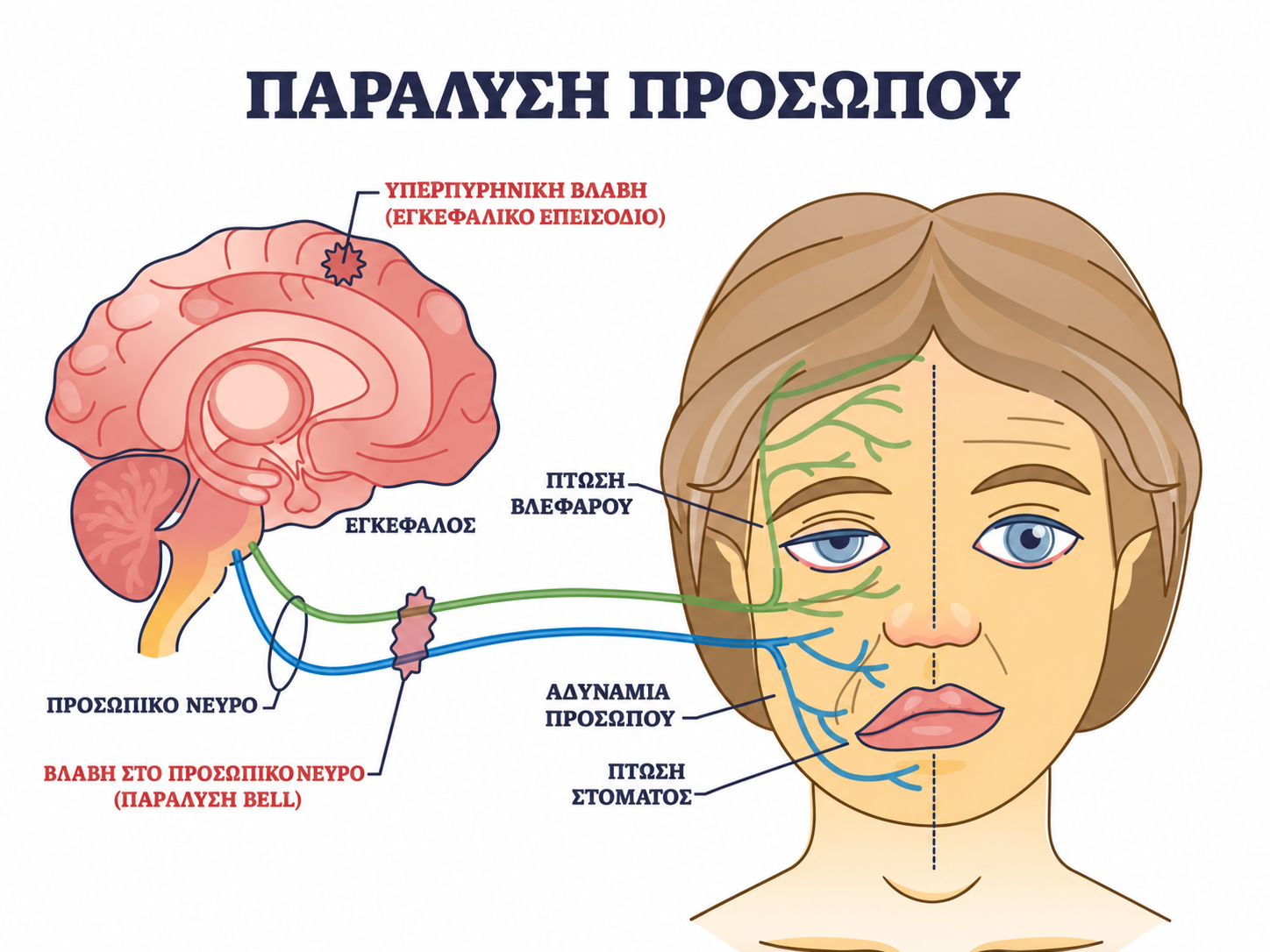 παραλυση προσωπου