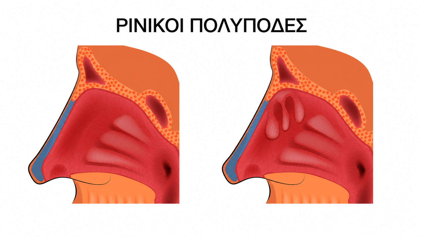 ρινικοι πολυποδες